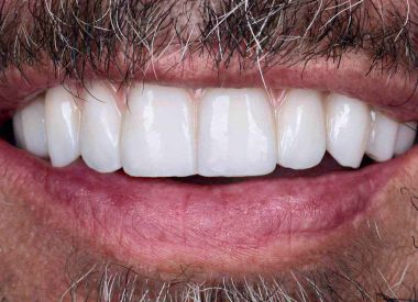 The patient returned to us two years later for a permanent prosthetic restoration. The reinforced provisional crowns looked satisfactory, with no chips, and the prostheses were immobile.