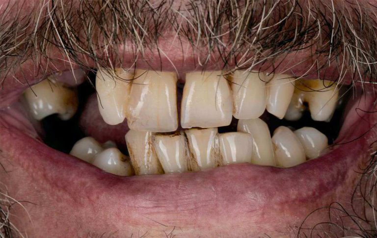 A patient from Portugal contacted the clinic with a request to get a beautiful smile. The check-up revealed that most of the teeth were loose; there was a foul smell and bleeding gums when brushing.