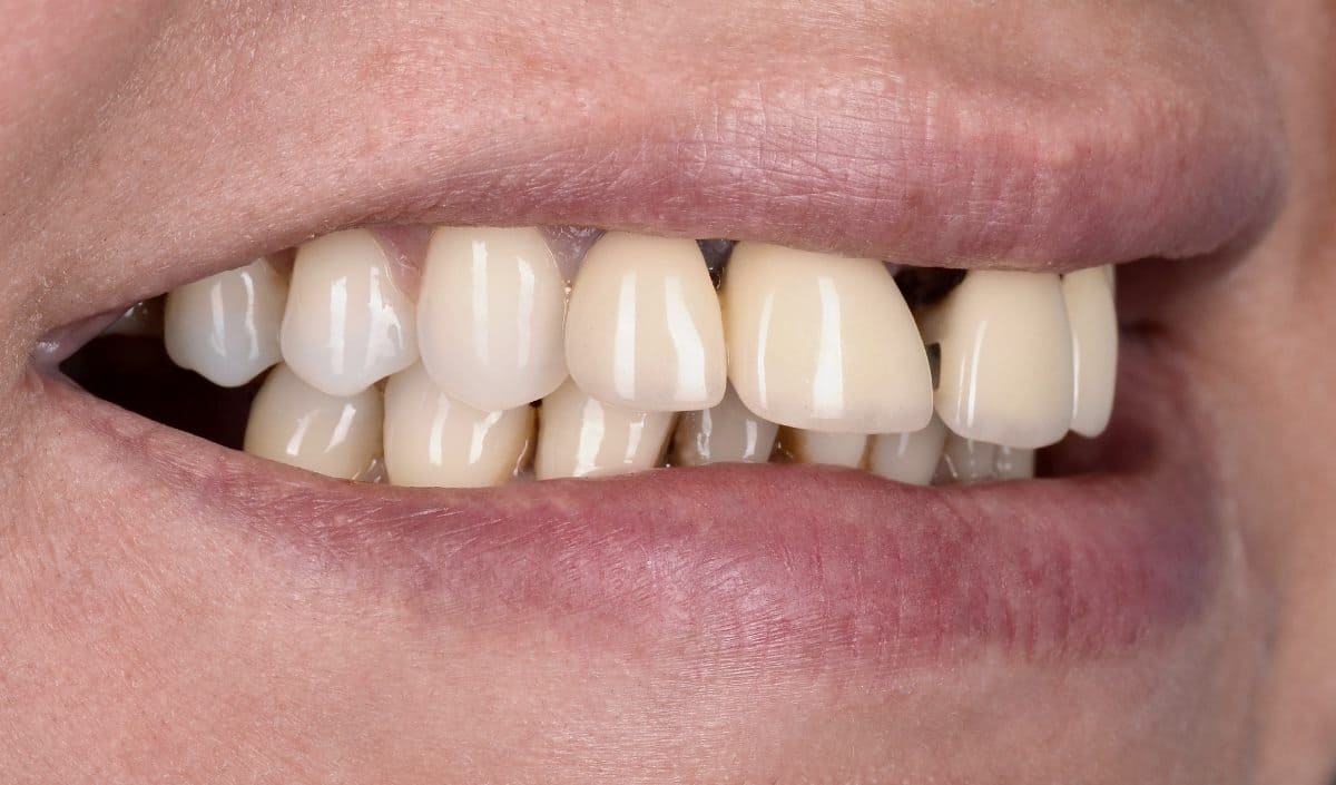 The patient had the porcelain fused to metal crowns on four extremely mobile upper incisors and a large diastema between the central incisors. All four incisors required extraction.