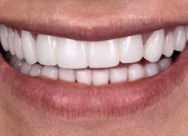 Four months later, the patient had implant-retained ceramic crowns and pin teeth.