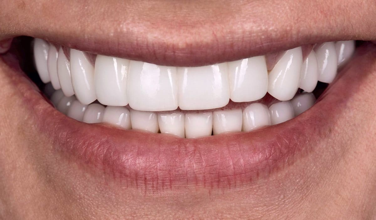 Four months later, the patient had implant-retained ceramic crowns and pin teeth.