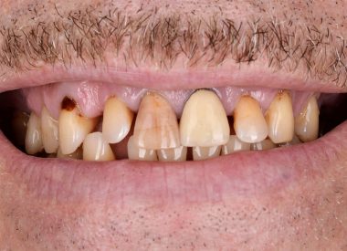 This patient had to make beautiful and functional restorations, which had to withstand an increased chewing load.