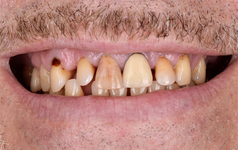Rehabilitation with zirconia crowns of occlusion pathology and teeth discoloration