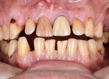 Нам предстояла непростая задача устранить промежутки между зубами, сделать все зубы одинакового более светлого цвета, изменить форму и незначительно увеличить высоту зубов
