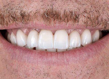 Нами было предложено протезирование всех зубов циркониевыми транспарентными коронками и винирами.
