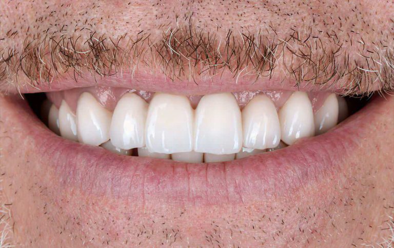 Rehabilitation with zirconia crowns of occlusion pathology and teeth discoloration