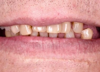 The patient lives abroad. He complained of tooth mobility in both jaws and was diagnosed with severe periodontitis of the 3rd stage.