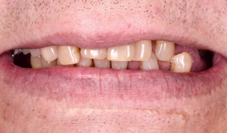 Пацієнт мешкає закордоном. Звернувся зі скаргами на рухливість зубів на обох щелепах. При обстеженні йому був поставлений діагноз: пародонтит 3 ступеню важкості.