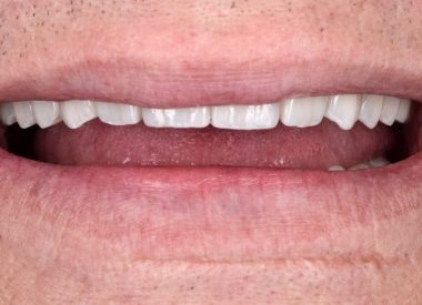 В один визит были удалены все зубы, установлены имплантаты Nobel Parallel на обе челюсти по протоколу "все-на- 4х" и фиксированы временные коронки на обе челюсти.