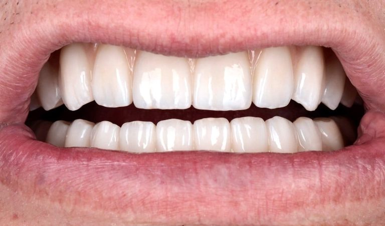 reabilitaciya-implantatamy-nobel-biocare-3