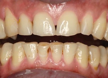 Пациент обратился с жалобами на стираемость зубов, множественные сколы режущих краев.