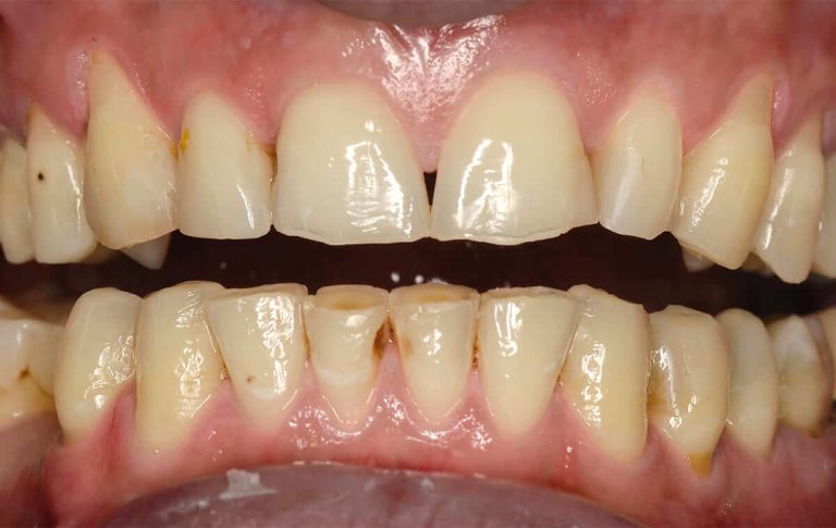 Пацієнт звернувся зі скаргами на стерті зуби, численні сколи ріжучих країв.