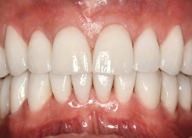 The patient sought to have beautiful white teeth. We proposed a restoration of damaged teeth with ceramic veneers.