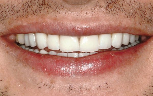 Реабилитация керамическими реставрациями при патологической стираемости зубов у пациента молодого возраста