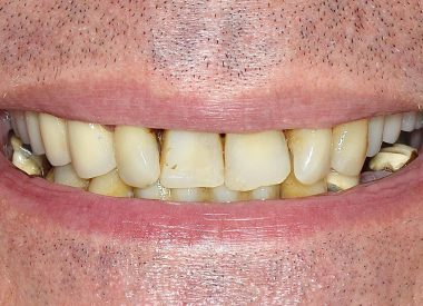 Диагноз: генерализованный пародонтит, частичная потеря зубов на нижней челюсти, подвижность оставшихся зубов II-III степени.