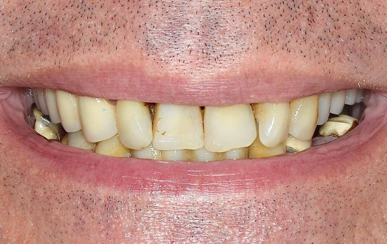Rehabilitation of a patient with generalized moderate severity periodontitis