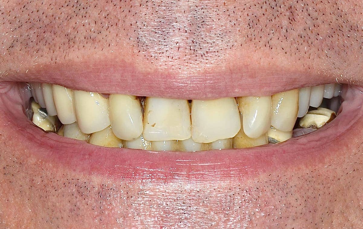 Діагноз: генералізований пародонтит, часткова втрата зубів на нижній щелепі, рухливість зубів, що залишилися ІІ-ІІІ ступеня.