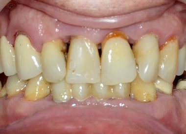 План лечения: принято решение удалить зубы III степени подвижности, оставить несколько зубов для фиксации временной конструкции на период приживления имплантатов. Нами было спланировано установить 8 имплантатов с последующим изготовлением металлокерамической конструкции на винтовой фиксации.