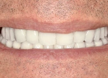 Following the placement of prosthesis the patient is satisfied with the aesthetic and practical result of the treatment. The color and shape of the teeth has changed.