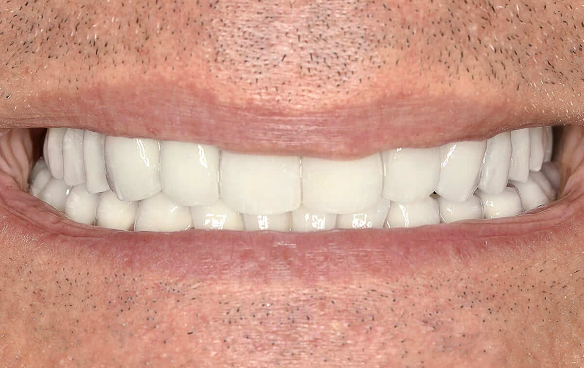 Після протезування пацієнт задоволений естетичним і функціональним результатом. Змінився колір і форма зубів.