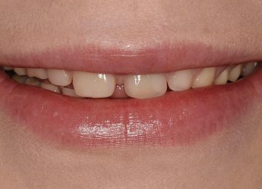 Patient has a pathological abrasion of hard dental tissue, old fillings that require replacement and discolouration of teeth.
