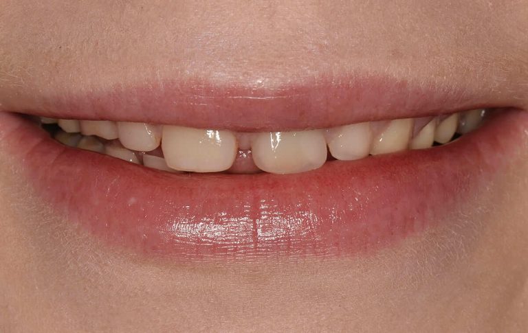 У пациентки патологическая стираемость: старые пломбы, требующие замены и дисколорит зубов.