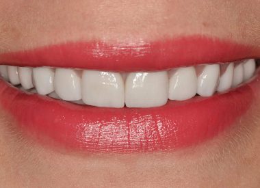 State of the mouth after placement of all-ceramic crowns and veneers.