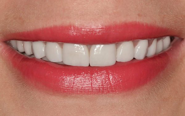 Ceramic restorations rehabilitation of patient with pathological teeth abrasion