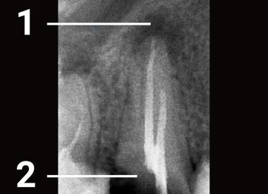 The patient contacted the clinic due to tooth decay, which was previously treated in another clinic. Some damaged bone tissue was discovered on the top of the root canal. 1 – bone tissue was damaged due to an incomplete treatment of the root canal 2 – crown of the tooth is damaged