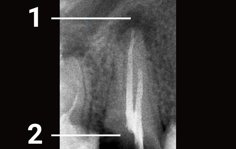 Пациент обратился в клинику по поводу разрушенности зуба, который ранее был лечен в другой клинике. На верхушке корня был обнаружен очаг разрушения костной ткани. 1 – разрушение костной ткани в результате неполного лечения канала 2 – коронковая часть зуба разрушена