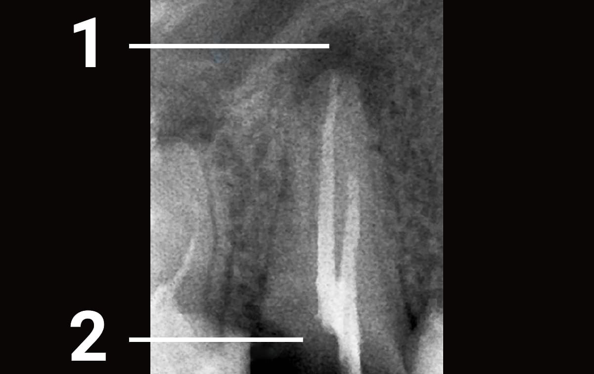 Пациент обратился в клинику по поводу разрушенности зуба, который ранее 
был лечен в другой клинике. На верхушке корня был обнаружен очаг разрушения костной ткани.
 
1 - разрушение костной ткани в результате неполного лечения канала

2 - коронковая часть зуба разрушена