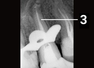 Было проведено перелечивание корневых каналов, их пломбировка и восстановление коронковой части зуба на стекловолоконных штифтах. 3 – корневые каналы зуба после пломбировки