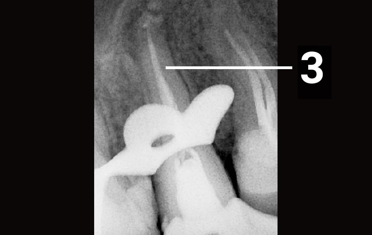 Было проведено перелечивание корневых каналов, их пломбировка и восстановление коронковой части зуба на стекловолоконных штифтах. 

3 - корневые каналы зуба после пломбировки
