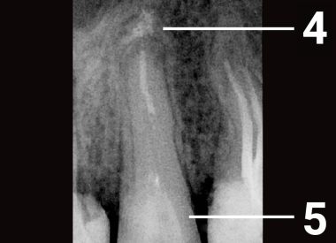 При повторному обстеженні через 9 місяців встановлено, що кісткова тканина в області верхівки зуба відновилася. 4 – через 9 місяців кісткова тканина відновилася 5 – відновлена на скловолоконних штифтах коронкова частина зуба