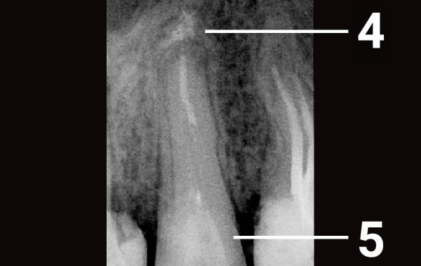 Treatment of a damaged tooth containing periodontitis