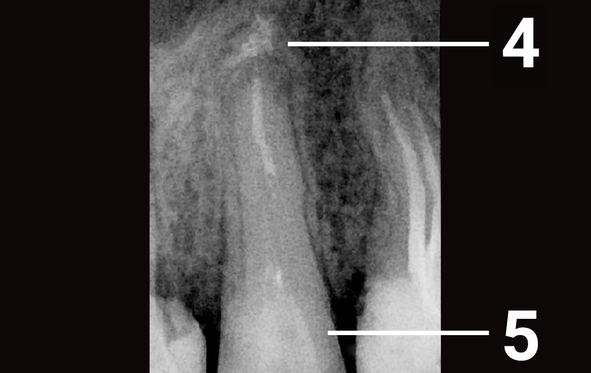 При повторном обследовании спустя 9 месяцев установлено, что костная ткань в области верхушки зуба восстановилась.

4 - спустя 9 месяцев костная ткань восстановилась

5 - восстановленная на стекловолоконных штифтах коронковая часть зуба
