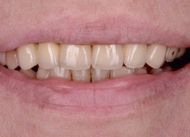 A patient did not like the aesthetic appearance of her old metal-ceramic crowns.