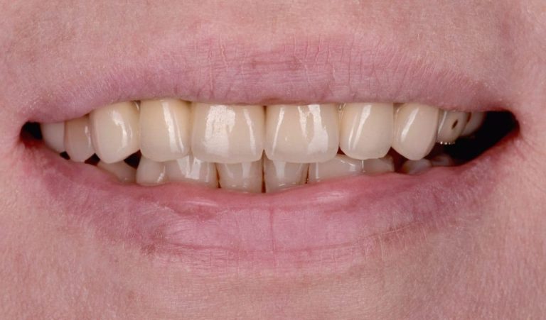 Failure of Metal-Ceramic Restorations. Zirconia restorations, creating a new smile