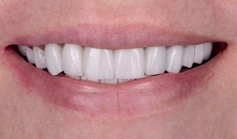 Failure of Metal-Ceramic Restorations. Zirconia restorations, creating a new smile