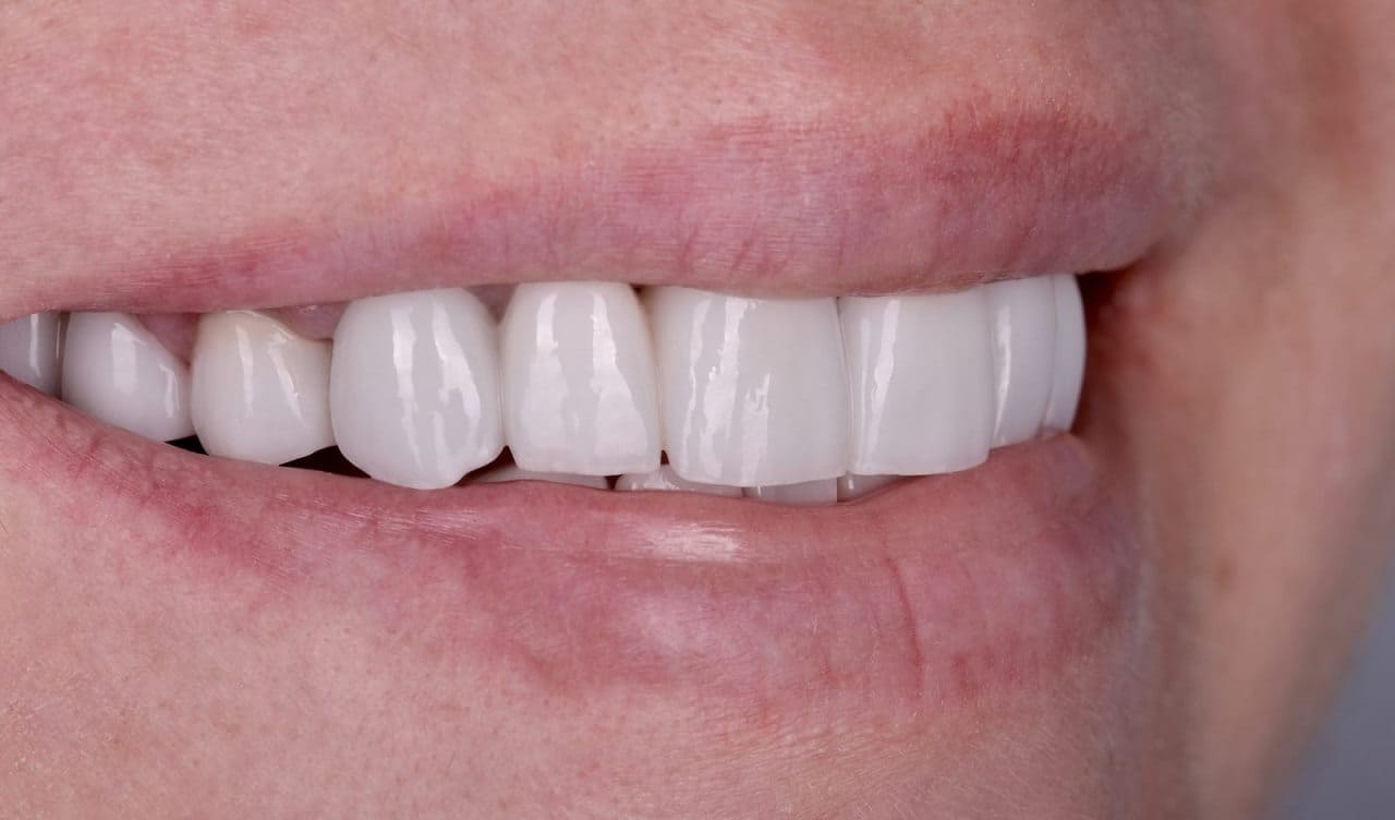 The patient was delighted with the result of her new smile.