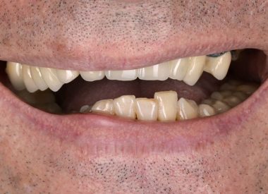 Пацієнт, який мешкає за кордоном, звернувся з бажанням отримати красиві зуби. В анамнезі він відзначив, що страждає пародонтитом більше 10 років і весь час відчував комплекс під час посмішки. Нам знадобилося всього шість відвідувань впродовж 4х місяців (два візити в Україну), щоб виготовити нові зуби.