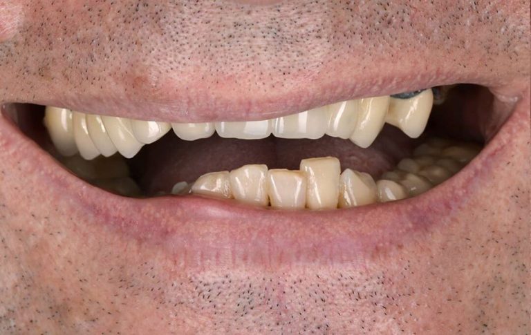 Пациент, живущий за рубежом, обратился с желанием получить красивые зубы. В анамнезе он отметил, что страдает пародонтитом более 10 лет и все время испытывал комплекс во время улыбки. Нам понадобилось всего шесть посещений в течении 4х месяцев (два визита в Украину), чтобы изготовить новые зубы.