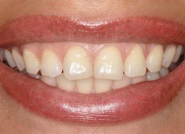 Пациентка обратилась в клинику с желанием закрыть диастемы и тремы (промежутки между зубами) на верхней челюсти.