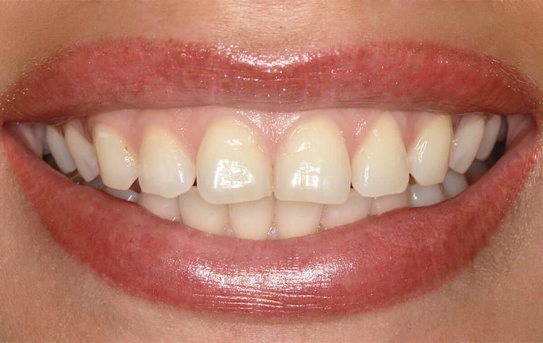 Пациентка обратилась в клинику с желанием закрыть диастемы и тремы (промежутки между зубами) на верхней челюсти.