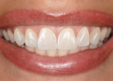 После согласования формы и цвета зубов проведена минимальная препаровка шести верхних фронтальных зубов, после чего информация была передана в зуботехническую лабораторию.