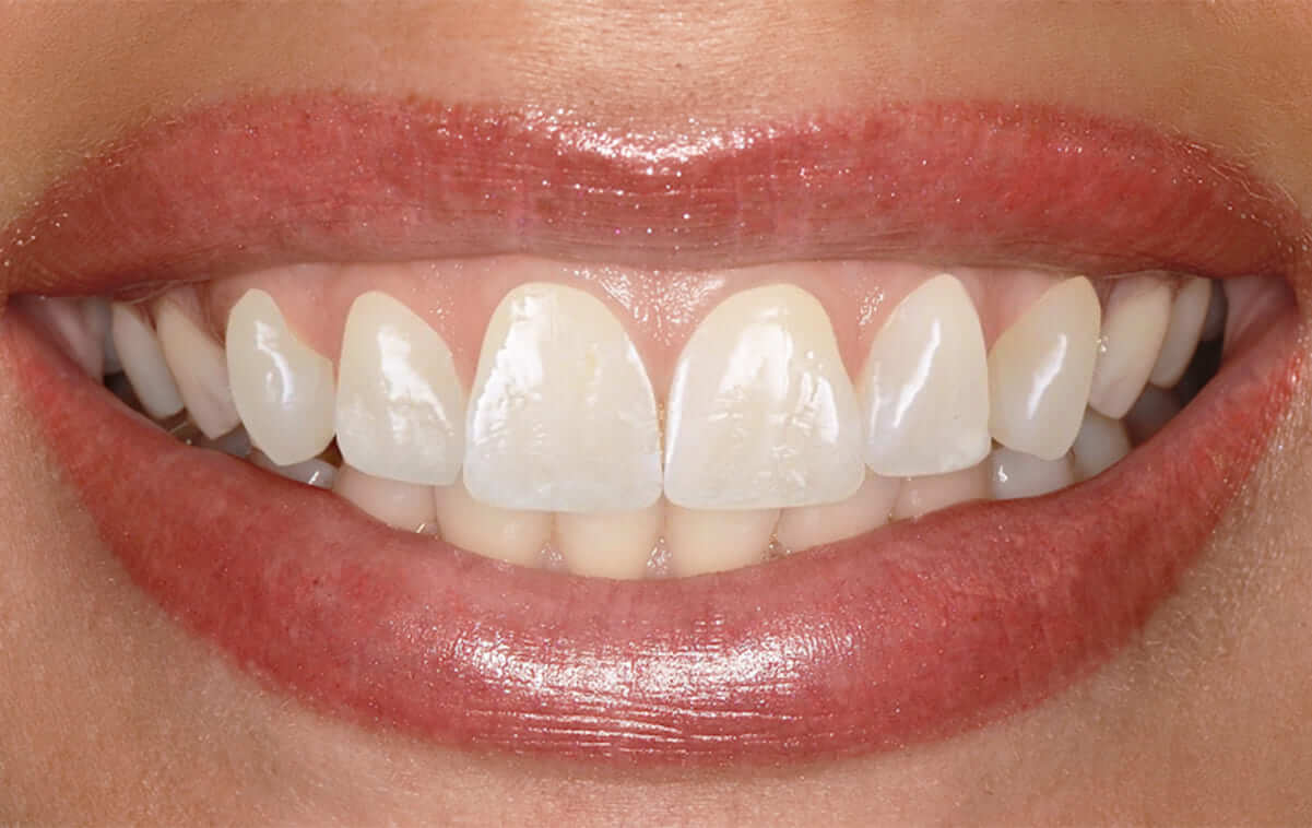 After agreeing on the shape and color of teeth with the patient, we carried out minimal filing of six upper front teeth, following which the information was transmitted to a dental laboratory.