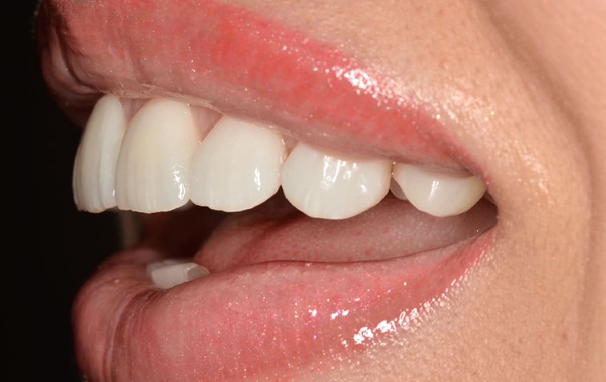 Ceramic veneers were made during a period of six weeks and were fixed in the patient's mouth.