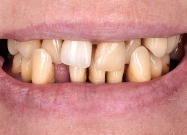 Пацієнтка звернулася зі скаргами на рухливість зубів, неприємний запах з рота, зуби змінили своє попереднє положення у зубному ряду. Також вона зазначила, що страждає пародонтитом довгі роки.