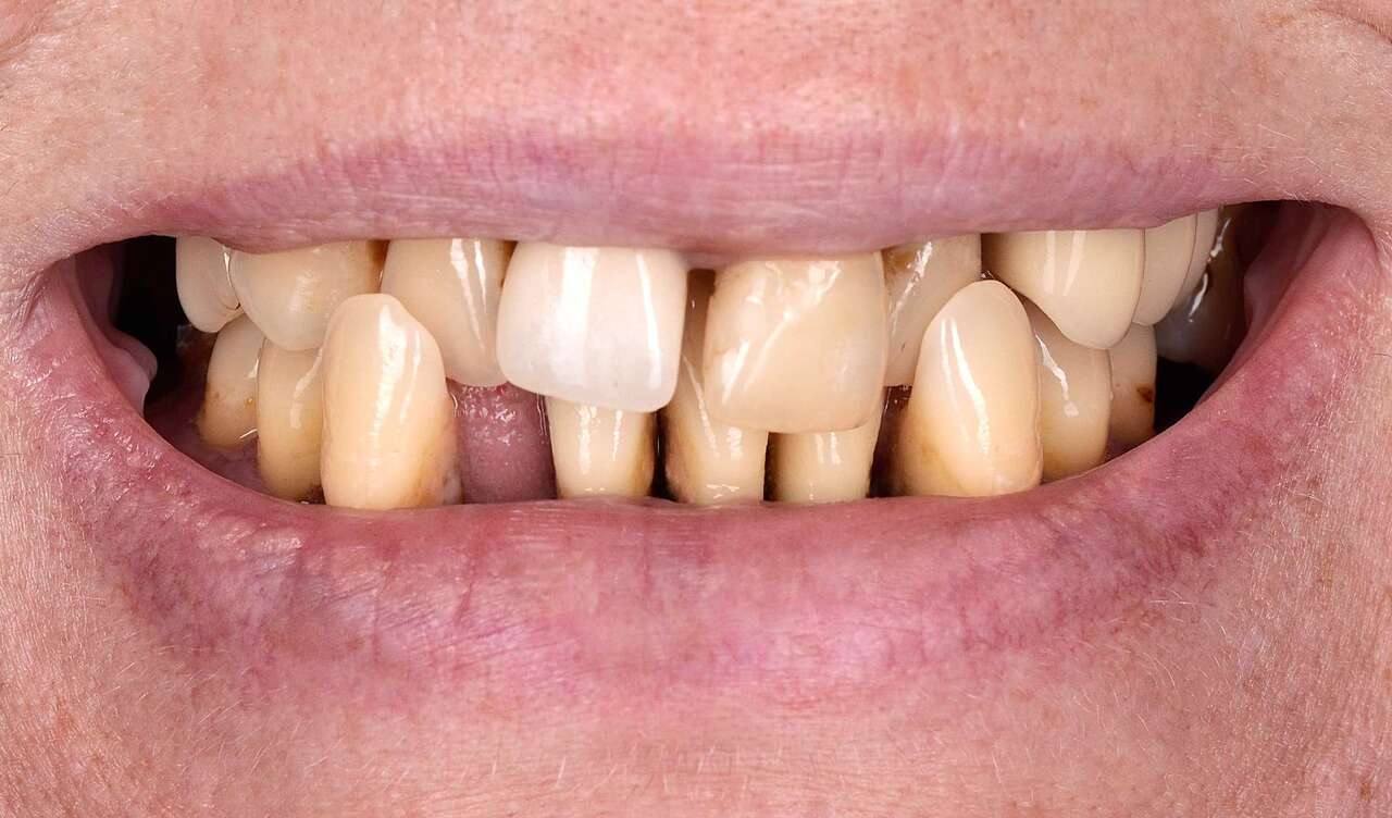 Пацієнтка звернулася зі скаргами на рухливість зубів, неприємний запах з рота, зуби змінили своє попереднє положення у зубному ряду. Також вона зазначила, що страждає пародонтитом довгі роки.