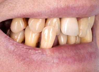При об'єктивному огляді більшість зубів мали сильну рухливість та підлягали видаленню.